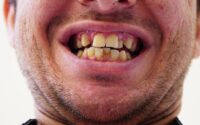 Usynlig og effektiv: Derfor vælger flere invisalign bøjle